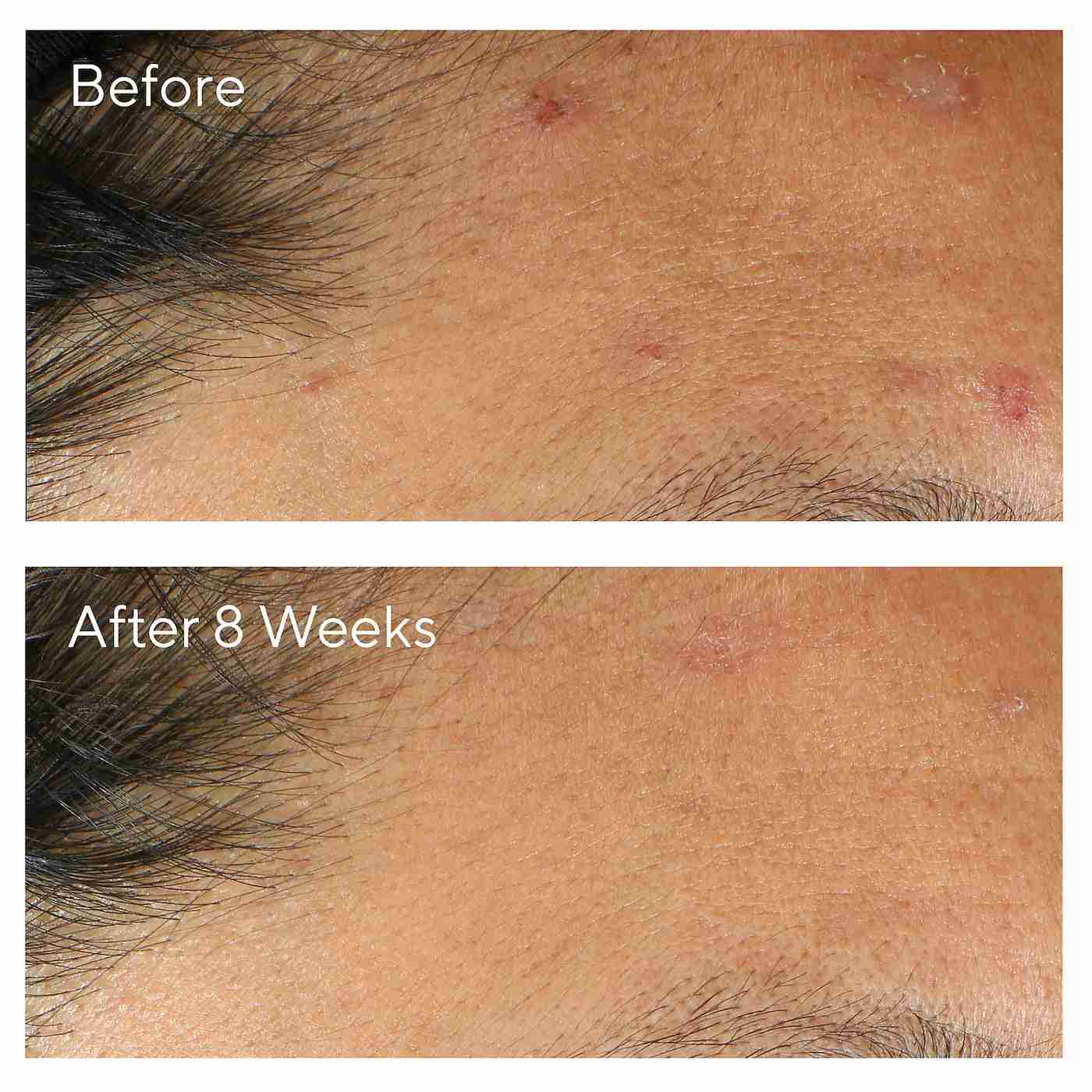 Murad invisiscar post - acne resurfacing treatment 4ml
