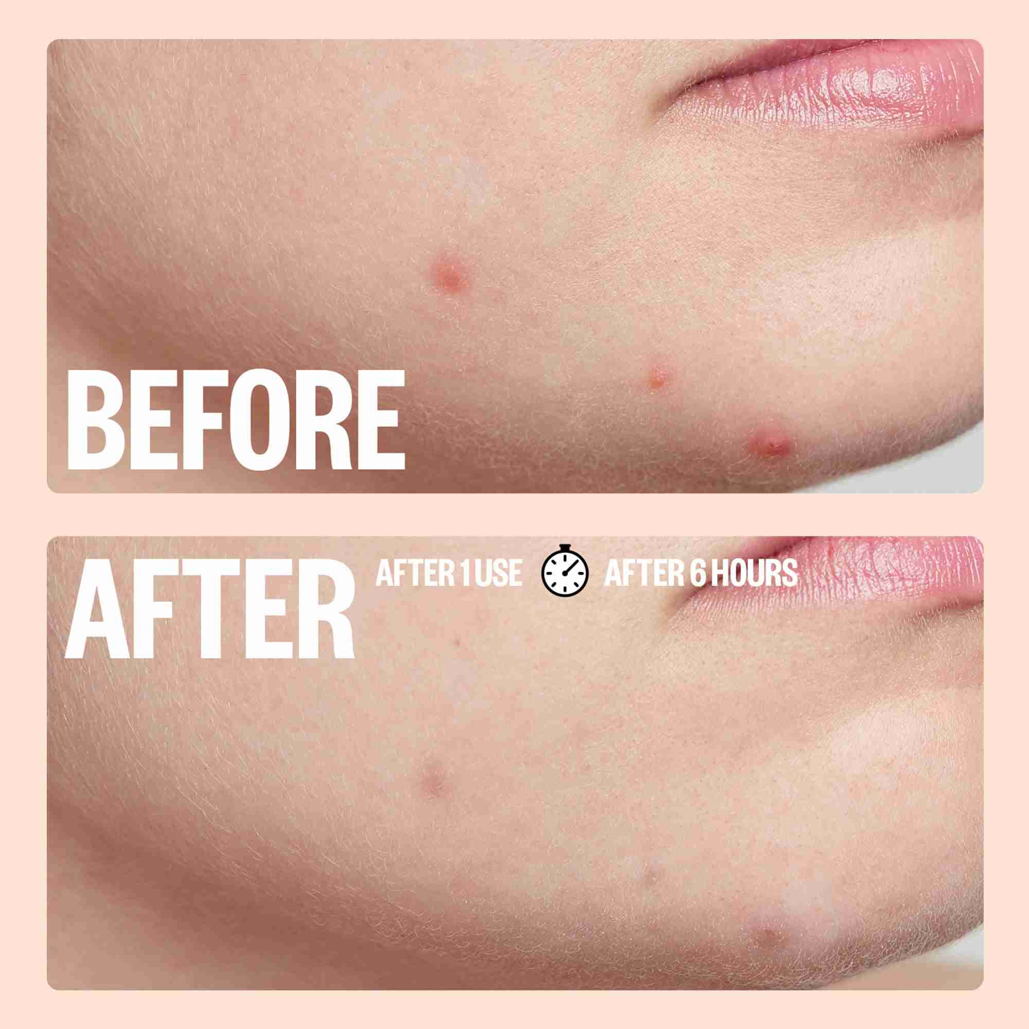 Peace out salicylic acid acne healing dots